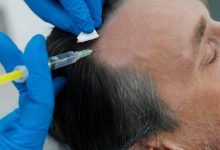 hair-loss-solutions-with-prp-treatment