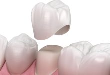 how-much-tooth-is-needed-for-a-dental-crown:-understanding-tooth-structure-and-restoration