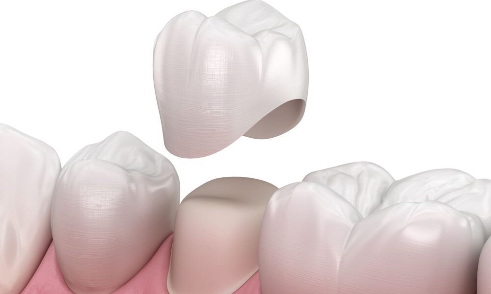 how-much-tooth-is-needed-for-a-dental-crown:-understanding-tooth-structure-and-restoration